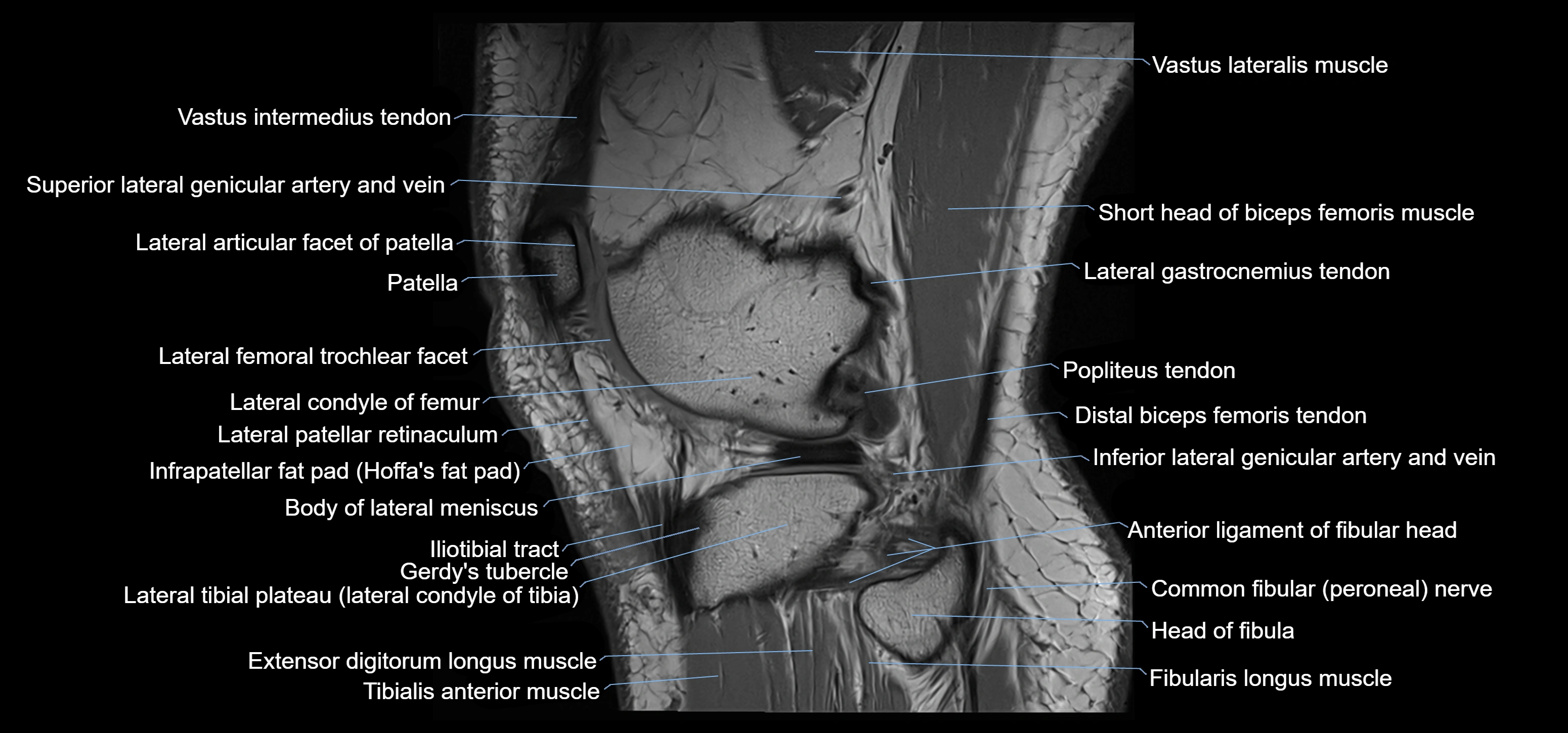 MRI knee sagittal cross sectional anatomy labelled 3T radiology image-00040.webp